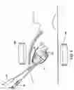 Fig. 11 - Apparatus and method for diagnosis and therapy of electrophysiological disease