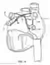Fig. 13 - Apparatus and method for diagnosis and therapy of electrophysiological disease