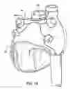 Fig. 18 - Apparatus and method for diagnosis and therapy of electrophysiological disease