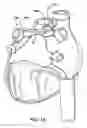 Fig. 19 - Apparatus and method for diagnosis and therapy of electrophysiological disease