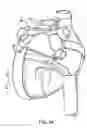 Fig. 32 - Apparatus and method for diagnosis and therapy of electrophysiological disease