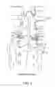 Fig. 02 - Facet joint fusion devices and methods