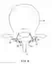 Fig. 08 - Facet joint fusion devices and methods