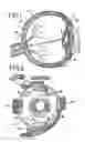 Fig. 02 - Ophthalmic clip and associated surgical method