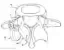 Fig. 01 - Facet joint replacement