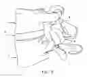 Fig. 04 - Facet joint replacement