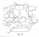 Fig. 05 - Facet joint replacement