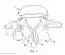 Fig. 06 - Facet joint replacement
