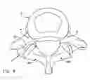 Fig. 08 - Facet joint replacement