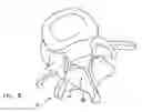 Fig. 10 - Facet joint replacement