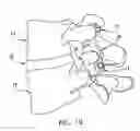 Fig. 12 - Facet joint replacement
