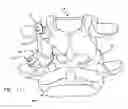 Fig. 13 - Facet joint replacement