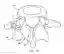 Fig. 14 - Facet joint replacement