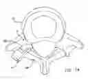 Fig. 16 - Facet joint replacement