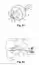 Fig. 09 - Methods for injecting a curable biomaterial into an intervertebral space
