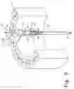 Fig. 06 - Adjustable orthopaedic prosthesis and associated method