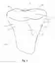 Fig. 02 - Tethered joint bearing implants and systems