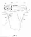 Fig. 11 - Tethered joint bearing implants and systems