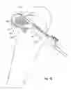 Fig. 16 - Tethered joint bearing implants and systems