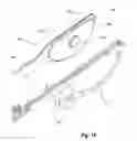 Fig. 20 - Tethered joint bearing implants and systems