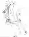 Fig. 22 - Tethered joint bearing implants and systems