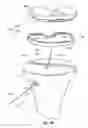Fig. 41 - Tethered joint bearing implants and systems