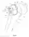 Fig. 42 - Tethered joint bearing implants and systems