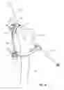 Fig. 45 - Tethered joint bearing implants and systems