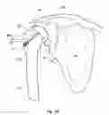 Fig. 60 - Tethered joint bearing implants and systems
