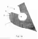 Fig. 02 - Device for radiation treatment of proliferative tissue surrounding a cavity in an animal body