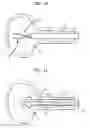 Fig. 07 - Urethral radiation treatment system and method