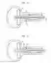 Fig. 09 - Urethral radiation treatment system and method