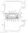 Fig. 01 - Intervertebral implant