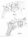 Fig. 02 - Shoulder implant assembly