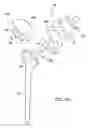 Fig. 04 - Shoulder implant assembly