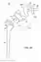 Fig. 05 - Shoulder implant assembly