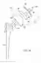 Fig. 10 - Shoulder implant assembly