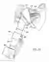 Fig. 27 - Shoulder implant assembly