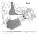 Fig. 02 - Transducer for electromagnetic hearing devices