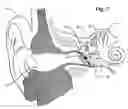 Fig. 03 - Transducer for electromagnetic hearing devices