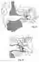 Fig. 04 - Transducer for electromagnetic hearing devices