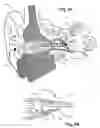 Fig. 05 - Transducer for electromagnetic hearing devices