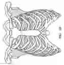 Fig. 13 - Ablation probe with stabilizing member