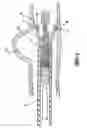 Fig. 09 - Expandable stent with markers and stent delivery system