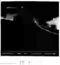 Fig. 09 - Bioabsorbable self-expanding endolumenal devices