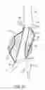 Fig. 07 - Methods and systems for endovascular aneurysm treatment