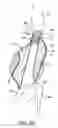 Fig. 08 - Methods and systems for endovascular aneurysm treatment