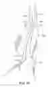 Fig. 11 - Methods and systems for endovascular aneurysm treatment