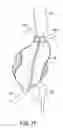 Fig. 15 - Methods and systems for endovascular aneurysm treatment