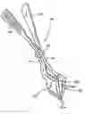 Fig. 01 - Intervertebral prosthesis placement instrument